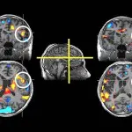 The clinical swallow evaluation with a focus on stroke
