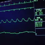 Managing post-extubation dysphagia