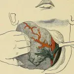 Dysphagia in Total Laryngectomy