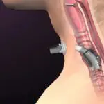 Tracheostomy tube cuff considerations: Impact, management, and purpose