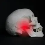 Managing head and neck cancer-induced trismus
