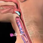 Clinical relevance of the sensorimotor pathways in  dysphagia management following tracheostomy