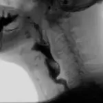 Stand up for standardization: Collaborative clarification for clinicians performing Modified Barium Swallowing Studies (MBSS)