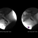 The Role of pressures in swallowing and impact of the Passy Muir® Valve