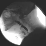 Impact of a Tracheostomy on Swallowing