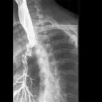 Perforations, fistulas and aspiration: Special considerations for Modified Barium Swallow Studies (MBSS)