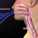 Airway Patency: What, When, How, and Why