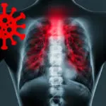 COVID-19 Complications and the Role of the SLP: An Acute Care Case Study