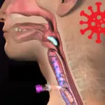 COVID-19 Complications and the Role of the SLP: An LTACH Case Study