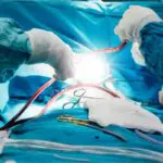 Swallow and Cough Function After Cardiac Surgery