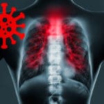 COVID-19 Complications and the Role of the SLP: An Acute Care Case Study