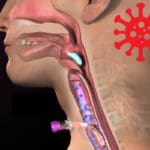 COVID-19 Complications and the Role of the SLP: An LTACH Case Study