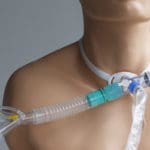 Swallowing with a Trach and Vent in the ICU: Part One