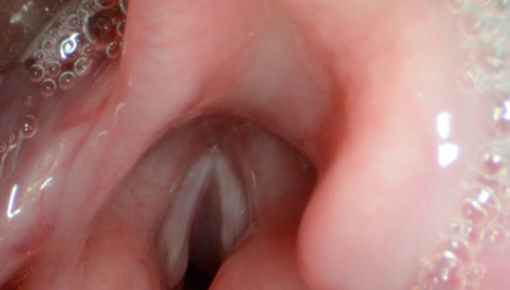 Vocal Cords Abducted and Dysphagia and assessment of swallowing
